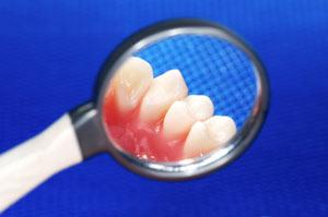 Periodontal/Gum Disease
